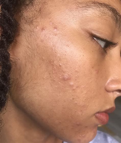 [Acne] I cannot clear up my sensitive, oily skin. Advice please : r/SkincareAddiction