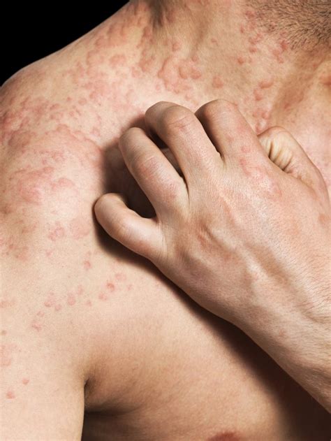 Common Shingles Rash Sites | Livestrong.com