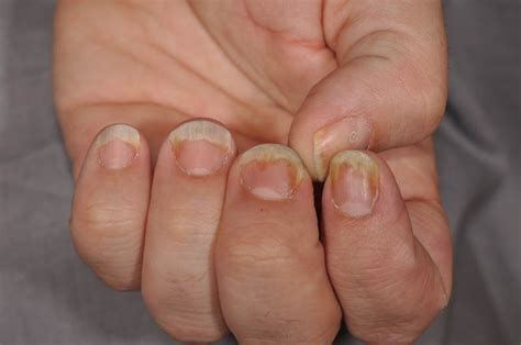 Nail Unit Psoriasis (Nail Psoriasis)