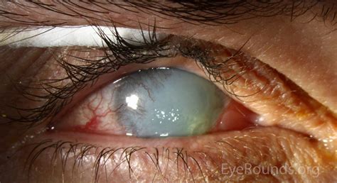 Painful Red Eye | Causes | Ophthalmology | Geeky Medics