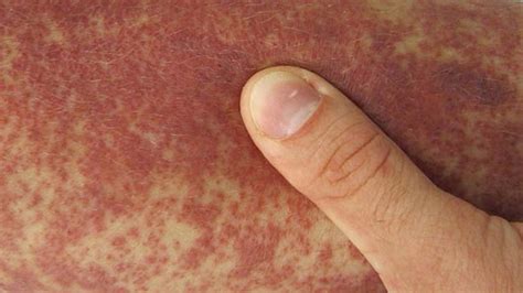 Purpura Rash Causes : The Cutaneous Manifestations Of Henoch Schonlein Purpura In Our Download ...