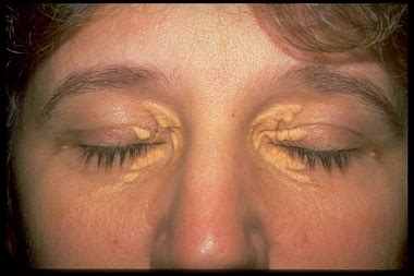 Xanthelasma Causes