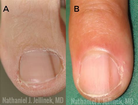 Melanoma Nail Symptoms