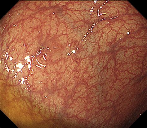 Icd 10 Code For Polyp Of Sigmoid Colon