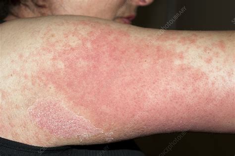 Allergic rash - Stock Image - C002/4042 - Science Photo Library