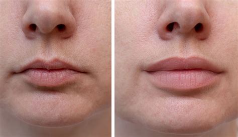 Lip Fillers: What to Expect, Types, Benefits & Side Effects