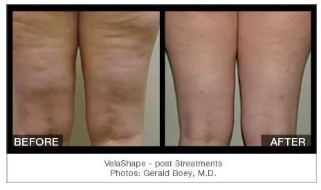 Velashape Before And After