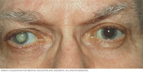 Cataracts - Symptoms and causes - Mayo Clinic