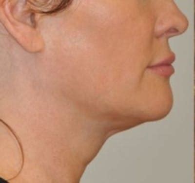 Neck Rejuvenation Before & After Photos | JUVA Skin & Laser Center