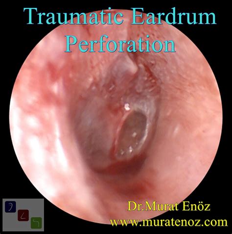 Ear Drum Repair (Tympanoplasty / Myringoplasty) in Istanbul