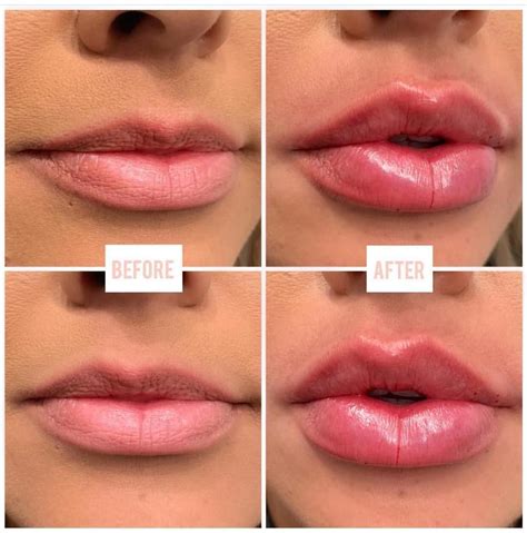 Lips by @lina_sev_ 1 Full Syringe of Juvederm Ultra XC Currently Taking appointments! Space is ...