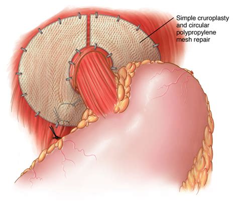 Types Of Hiatal Hernia Surgery