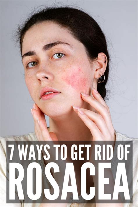 How to Get Rid of Rosacea: 7 Rosacea Remedies That Work | Rosacea, Rosacea remedies, Rosacea redness