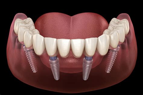 Learn the Benefits of All-on-4 Dental Implants in Loveland