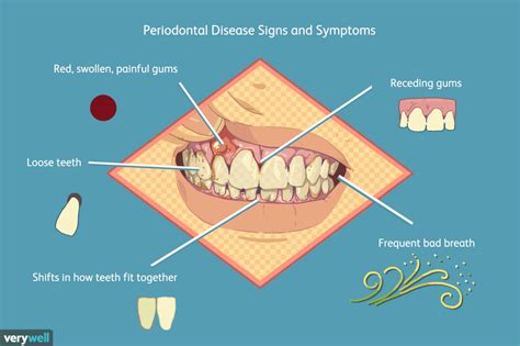 The Connection Between Diabetes and Periodontal Disease
