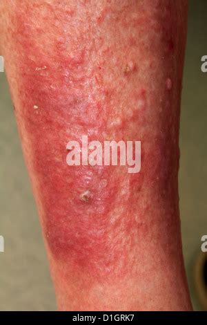 Eczema Stock Photo - Alamy
