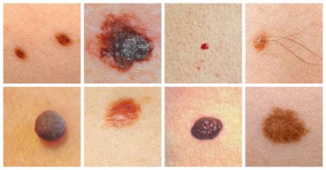 Is Your Mole Cancerous? Detecting Skin Cancer with Dermoscopy