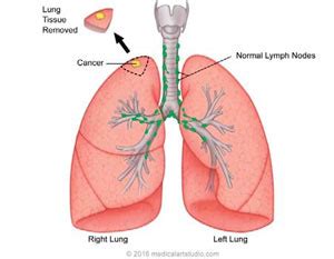 Lung Resection | RWJBarnabas Health