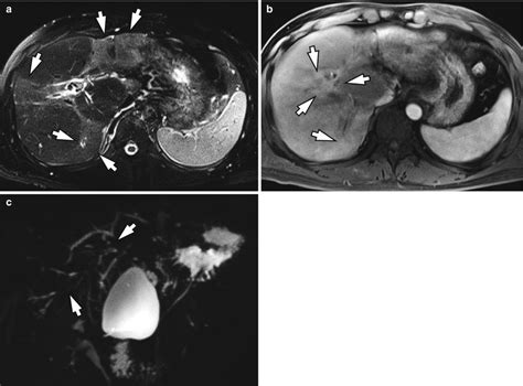 Cholangitis | Radiology Key