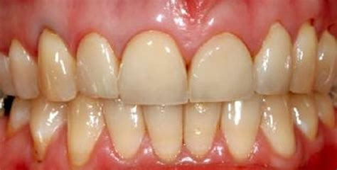 Swollen Gums - Symptoms, Causes, Treatment, Pictures - HubPages