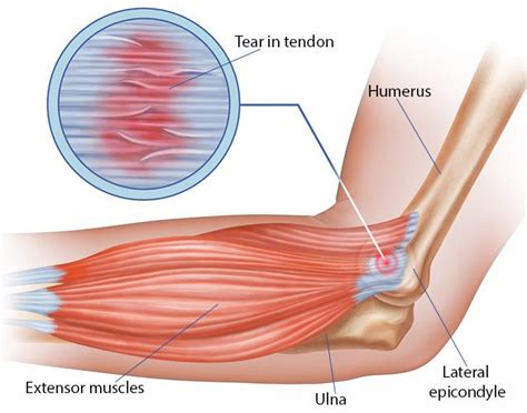 Elbow Tendonitis Treatment in NYC | New York Pain Care