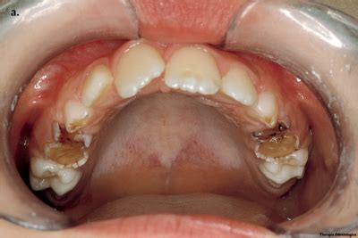 Dentinal dysplasia type II