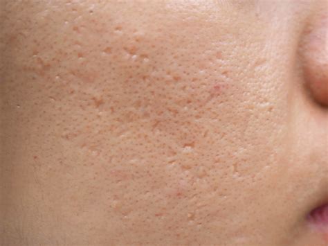 Acne Dark Spots On Face