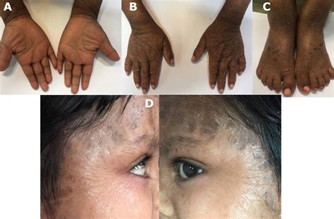 Mild Lamellar Ichthyosis