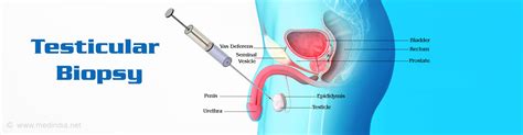 Testicular Biopsy - Types, Procedure, Precautions, Risks & Results