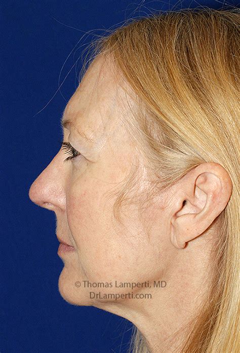 Rhinoplasty | Seattle Facial Plastic Surgeon| Dr. Lamperti | Seattle, WA