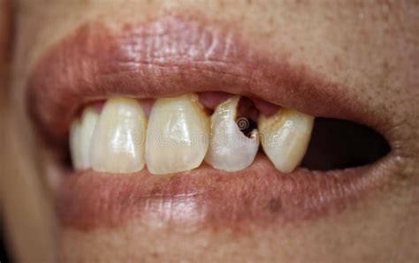 Decaying maxillary teeth stock image. Image of care - 263781563