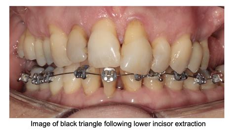 Lower incisor extraction in orthodontics: Dastardly or excellence? - Orthodontics in Summary