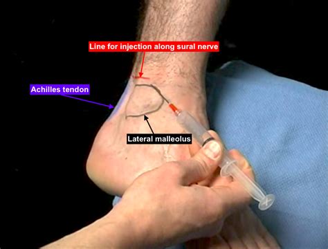 Lower Extremity Nerve Block: The Sural Nerve | SinaiEM