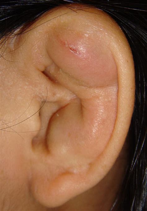 What’s the Cause of a Woman’s Recurrent Left-Sided Ear Lesion? | Consultant360