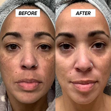 Witness the Transformation: Hyperpigmentation Tretinoin Before & After