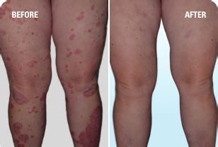 Psoriasis Before & After Pictures | SKYRIZI® (risankizumab‐rzaa)