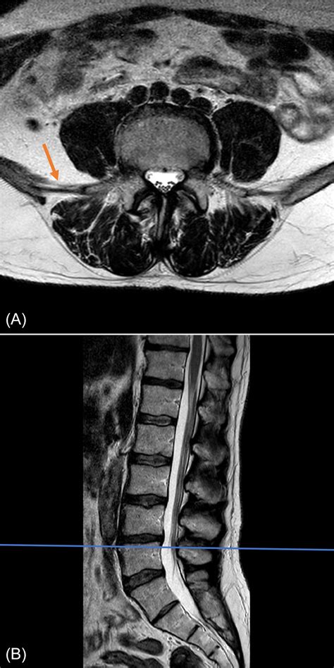 Lumbosacral Spine MRI | Radiology Key