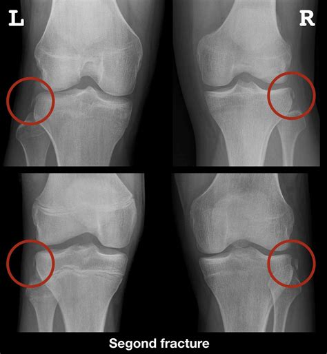 Segond fracture • LITFL Medical Blog • Medical Eponym Library