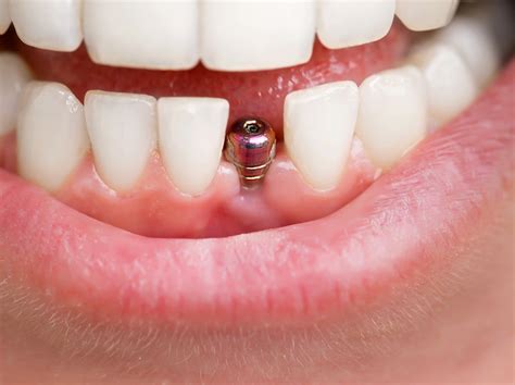 Tooth Implant Placement: Before, During, After - General and Cosmetic Dentistry | The Plano Dentist