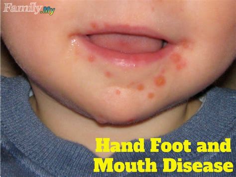 Can Adults Get Hand Foot And Mouth Disease Treatment at Jason Boyce blog