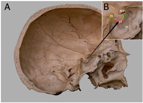 Brain Sciences | Free Full-Text | Morphology of the Sella Turcica: A ...