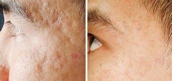 Derma Roller Before & After Pictures|Acne Scars, Stretch marks etc