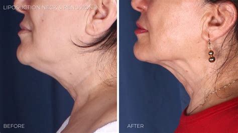 Neck Lift Alternatives: Surgical & Non-surgical Options | Omaha Cosmetic Center