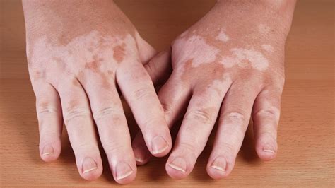 Hammerling: Got white spots on your skin? It could be vitiligo