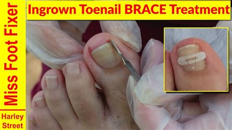 Ingrown Toenail Brace Treatment Miss Foot Fixer Marion Yau - YouTube