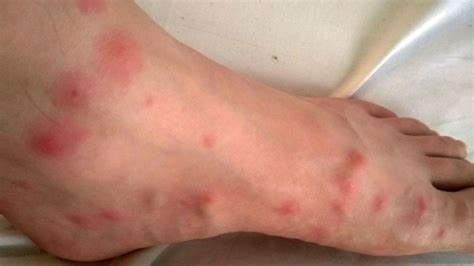 Midge Bites (Symptoms, What They Look Like, and How to Treat ...