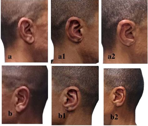 ((a), (b)). Before macrotia surgery. ((a1), (b1)). 3 months after... | Download Scientific Diagram