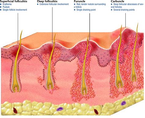 Carbuncle Vs Furuncle