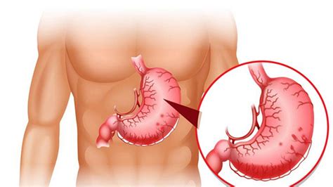 Atrophic gastritis: Causes, symptoms and treatment | Vinmec