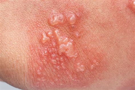 Tagamet for Warts and Shingles! | The People's Pharmacy